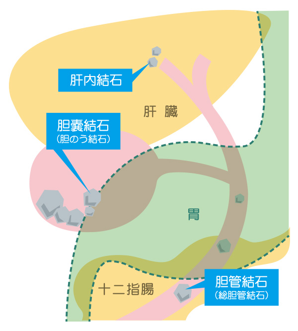 痛み 緩和 胆石 胆石症ガイド｜患者さんとご家族のためのガイド｜日本消化器病学会ガイドライン